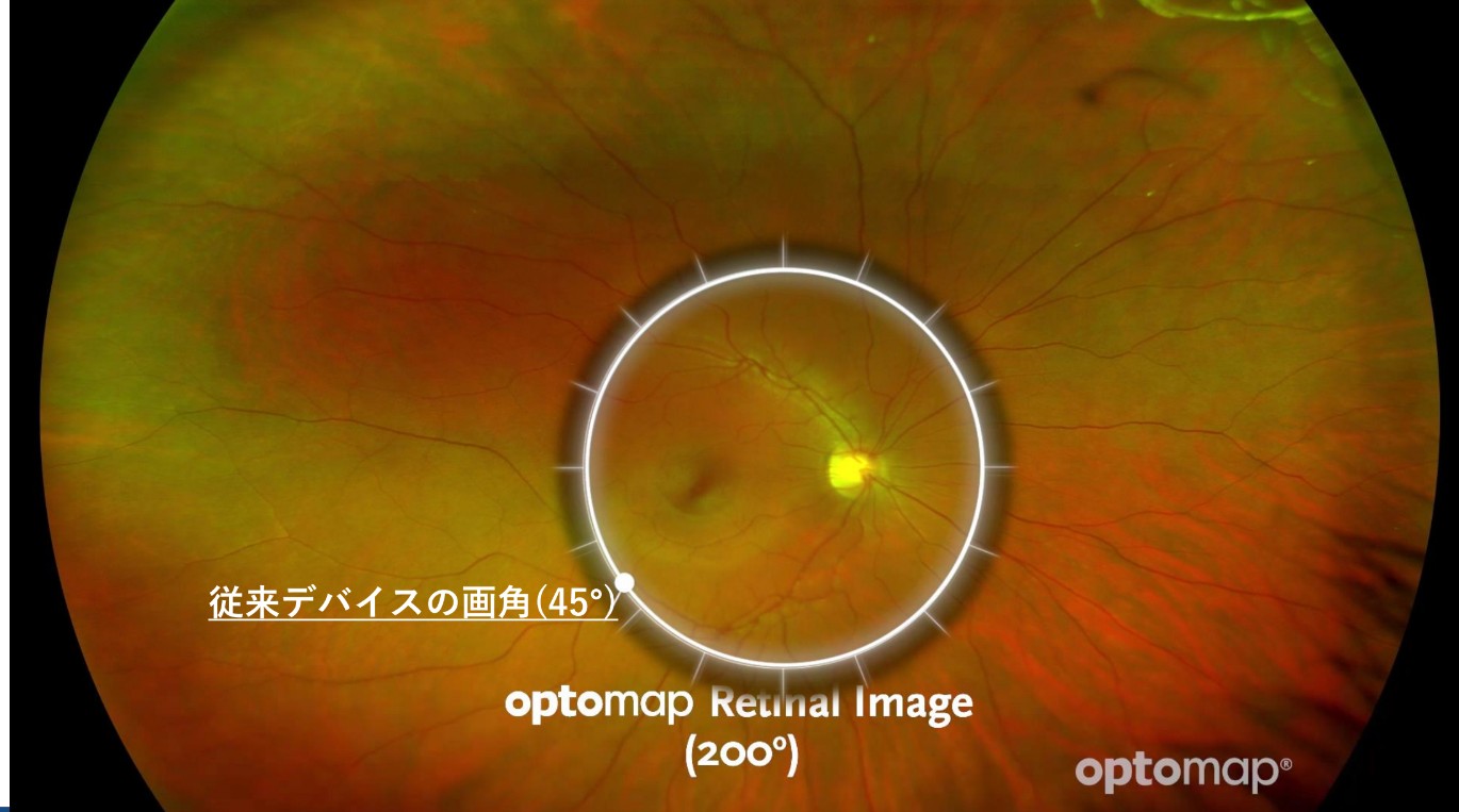 Optos Daytona Nextの撮影画像
